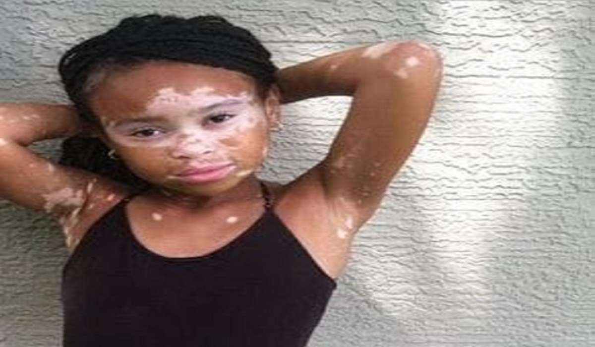 Vitiligo Leukoderma Fear Of Getting White Skin Tags Know The Symptoms 3396