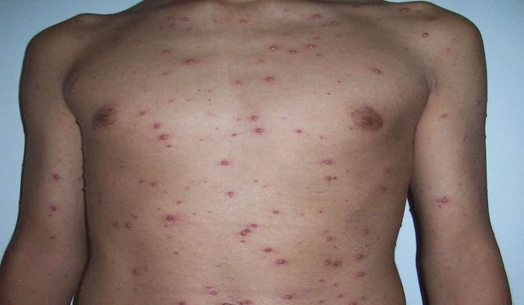 Measles Outbreak in Mumbai: मुंबईत गोवरने बाधित बालकाचा मृत्यू