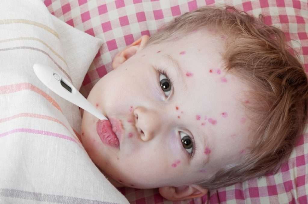 Measles Disease गोवरचा राज्यात धुमाकूळ! आतापर्यंत १८ बालकांचा मृत्यू