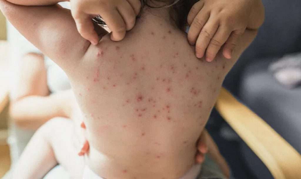 Measles Outbreak : मुंबई, ठाण्यानंतर भिवंडी, नाशिक, मालेगावात गोवरचा मोठ्या प्रमाणात शिरकाव; राज्य सरकारकडून तातडीची बैठक